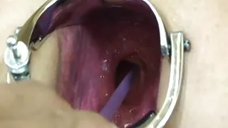 المر, عکس کس ایرانی شدید speclum - anal gape!- kak1